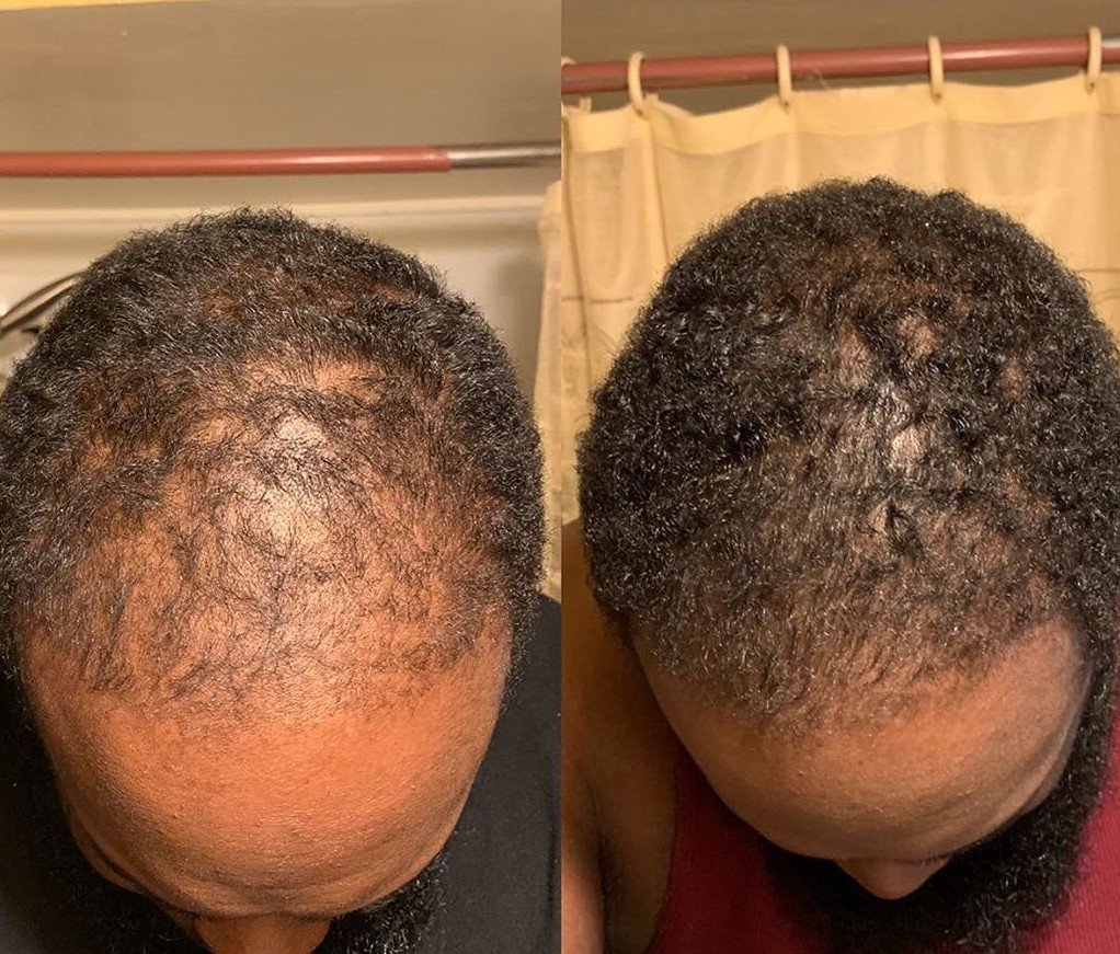 Select Does Batana Oil Regrow Hair? An Evidence-Based Guide Backed by Tradition and Real User Experiences Does Batana Oil Regrow Hair?