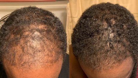 Select Does Batana Oil Regrow Hair? An Evidence-Based Guide Backed by Tradition and Real User Experiences Does Batana Oil Regrow Hair?